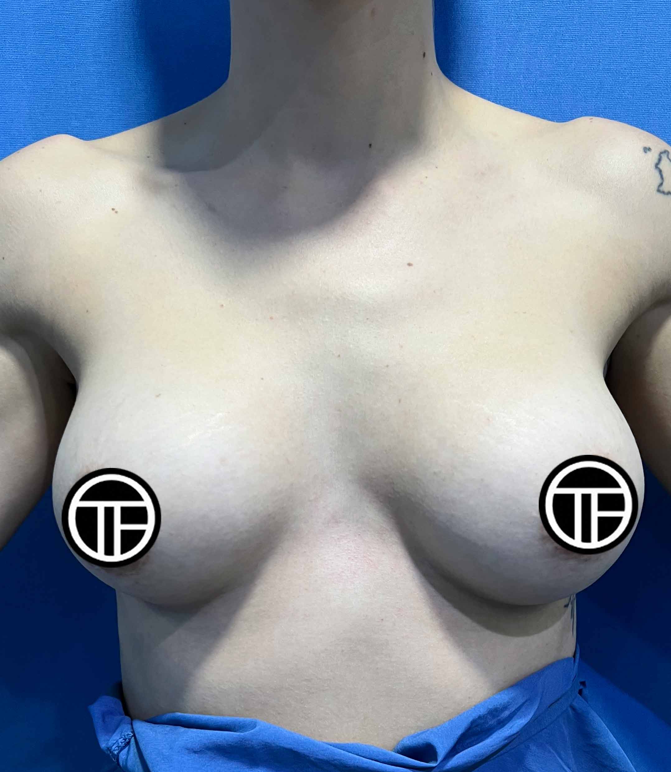 Cambio de protesis de seno Medellin