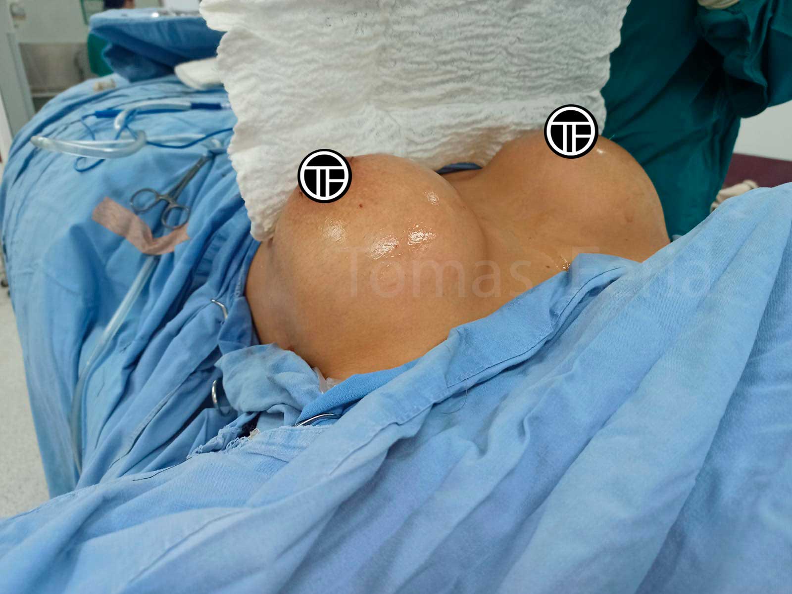 Cambio de protesis de seno Medellin