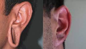 Reparación de lobulo de oreja Medellin